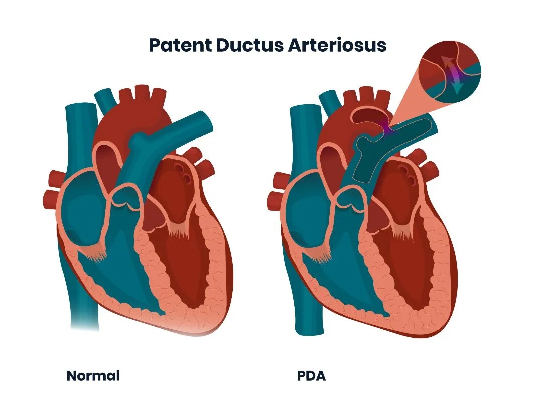 Patent Ductus Arteriosus (PDA) Symptoms and Risk Factors Dr Raghu