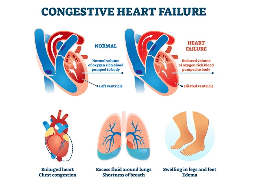 Diagnosing Congestive Heart Failure Dr Raghu