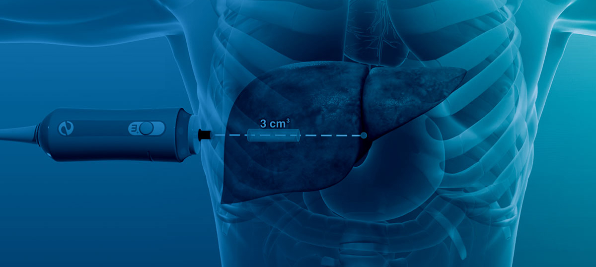 Fibroscan test price Fibroscan test in Faridabad