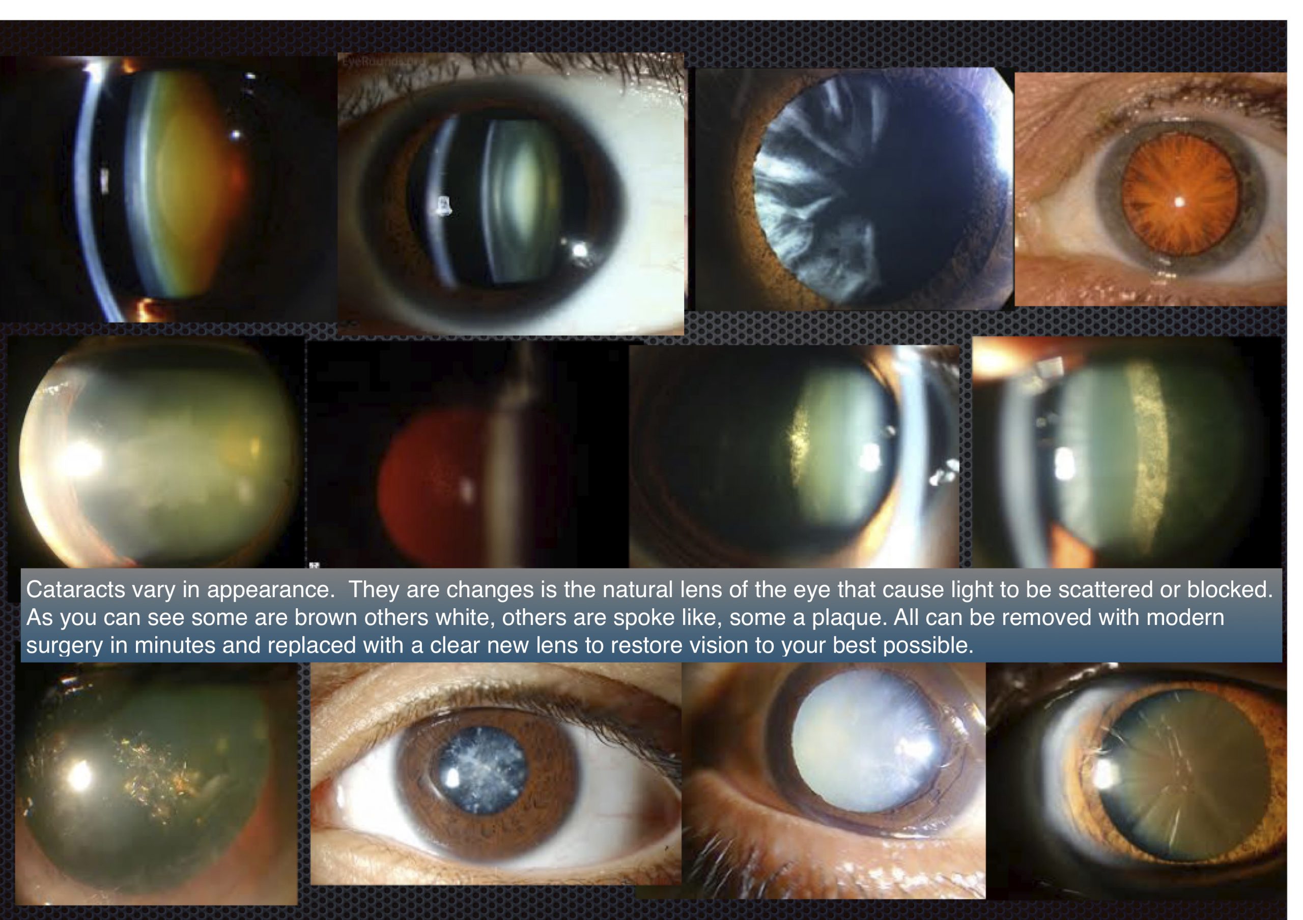 What are cataracts? - Dr Ray Radford