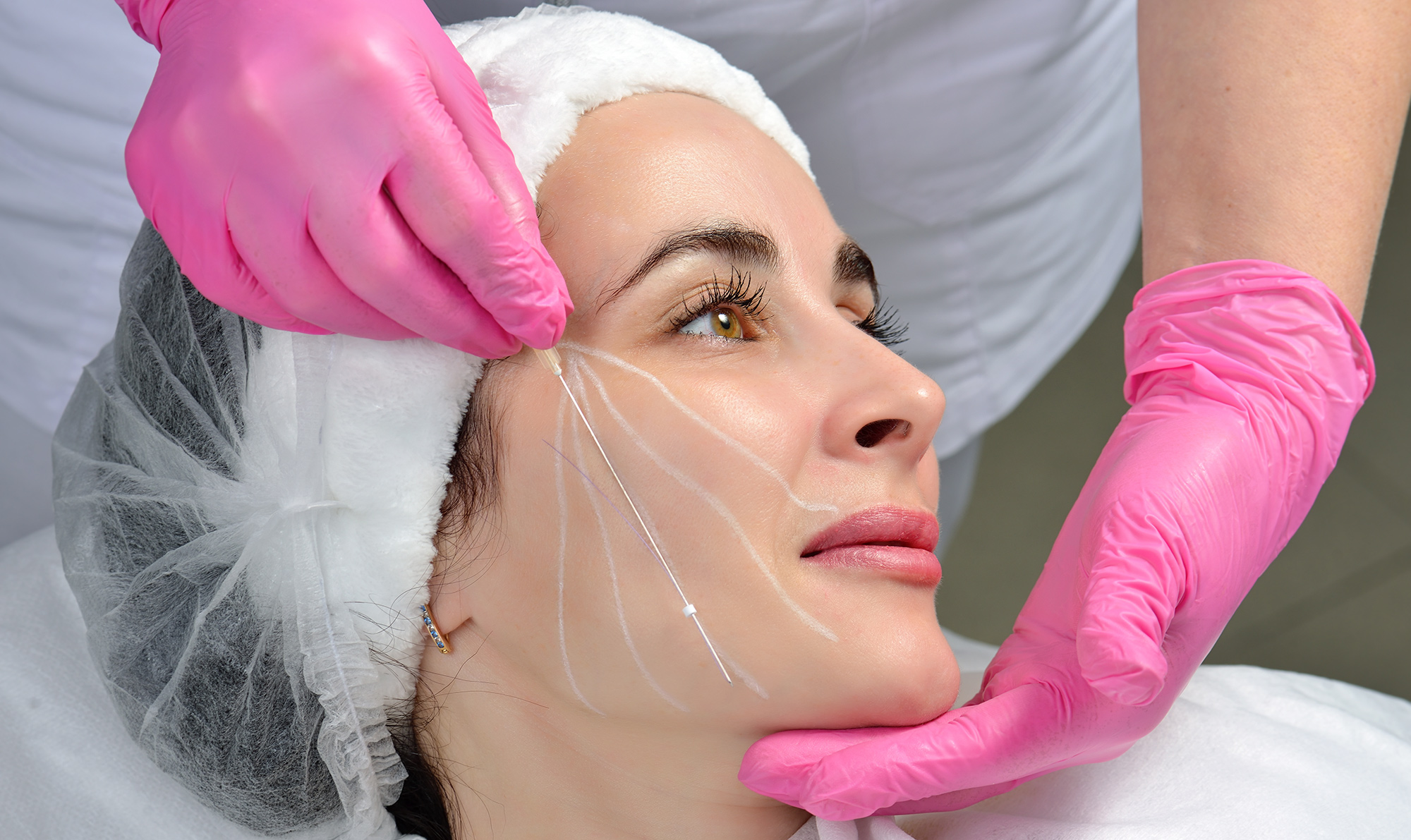 Thread Lift Singapore NonSurgical Facelift