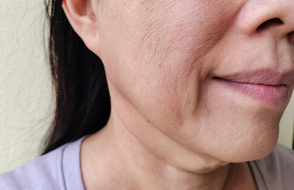 Thread Lift Singapore NonSurgical Facelift