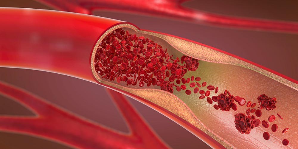 Cardiac Catheterization Specialist Cardiologist In Delhi Dr Ripen Gupta