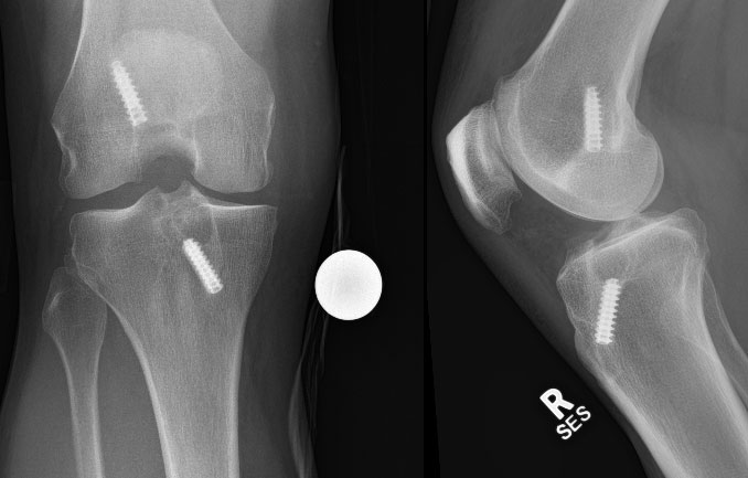 Live ACL Reconstruction Surgical Demonstration | Robert LaPrade, MD