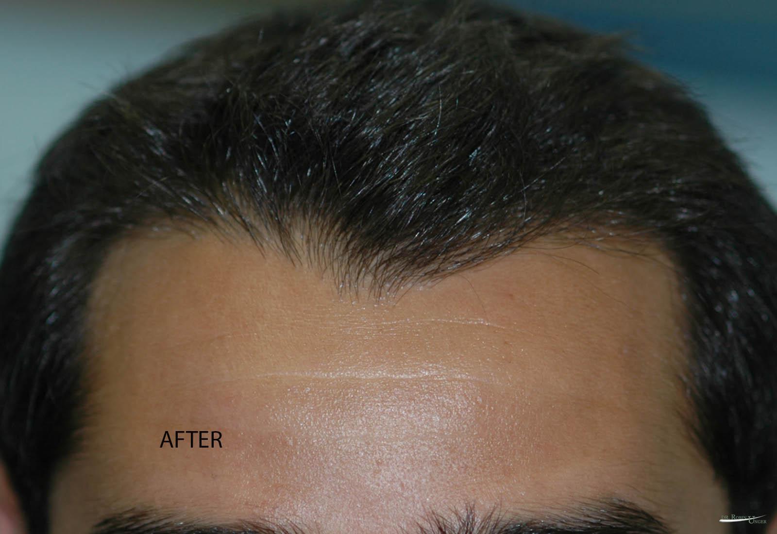 New York male hair transplant surgery Dr. Robin Unger Dr. Robin