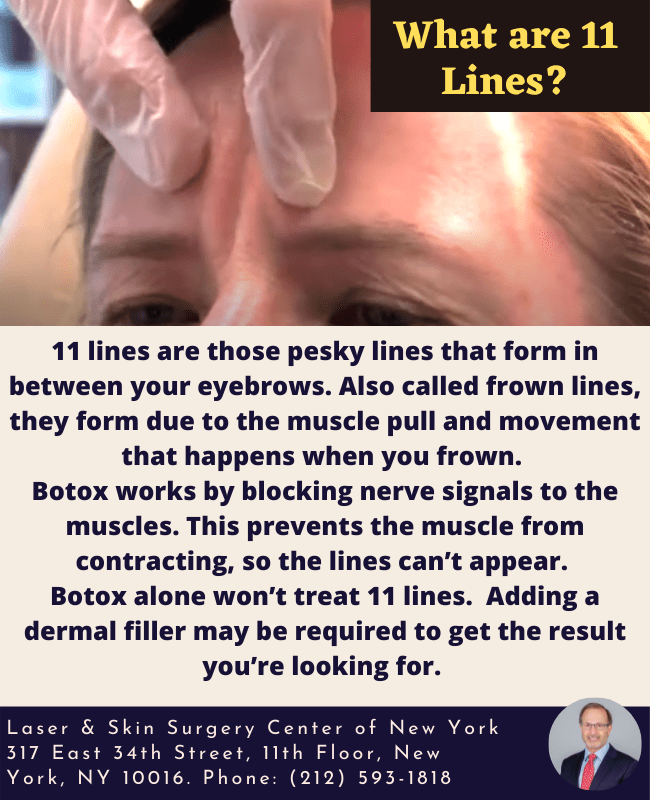 Have you got 11 lines between your eyebrows? Dr. Ron Shelton