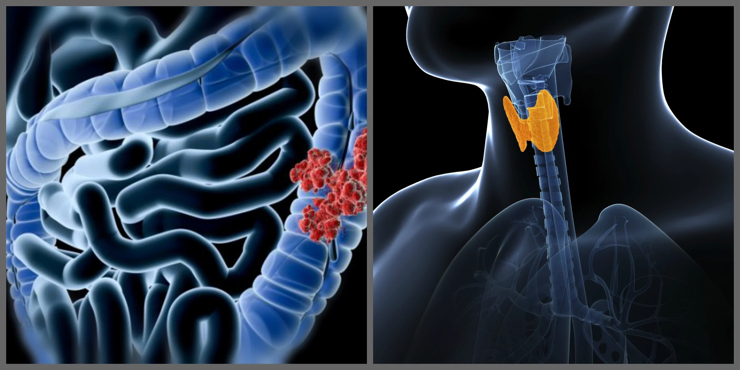 Three Simple Tips to Lower Thyroid Antibodies and Prevent Hypothyroidism