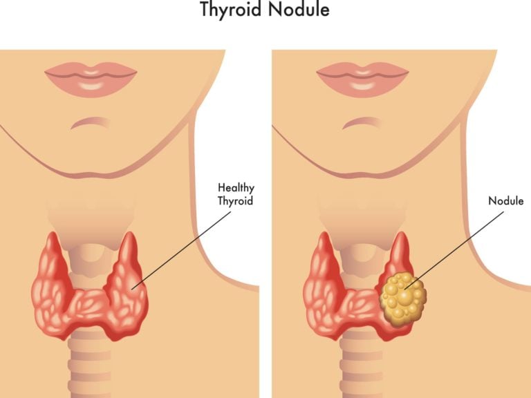 What Causes Thyroid Nodules To Grow?