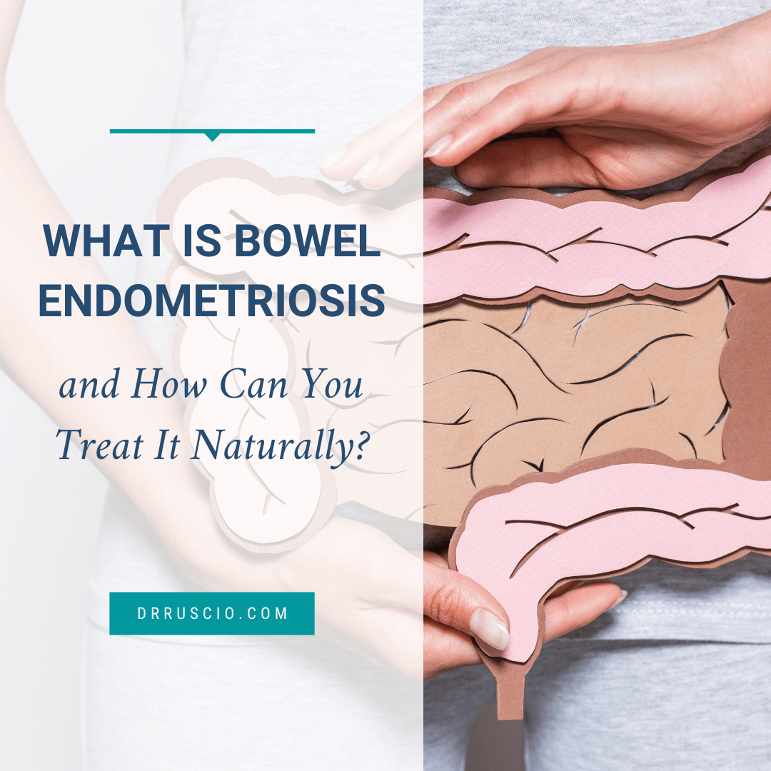 What Is Bowel Endometriosis and How Can You Treat It?