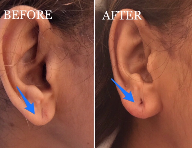 Dermal Filler for Ears? Dr Sabba