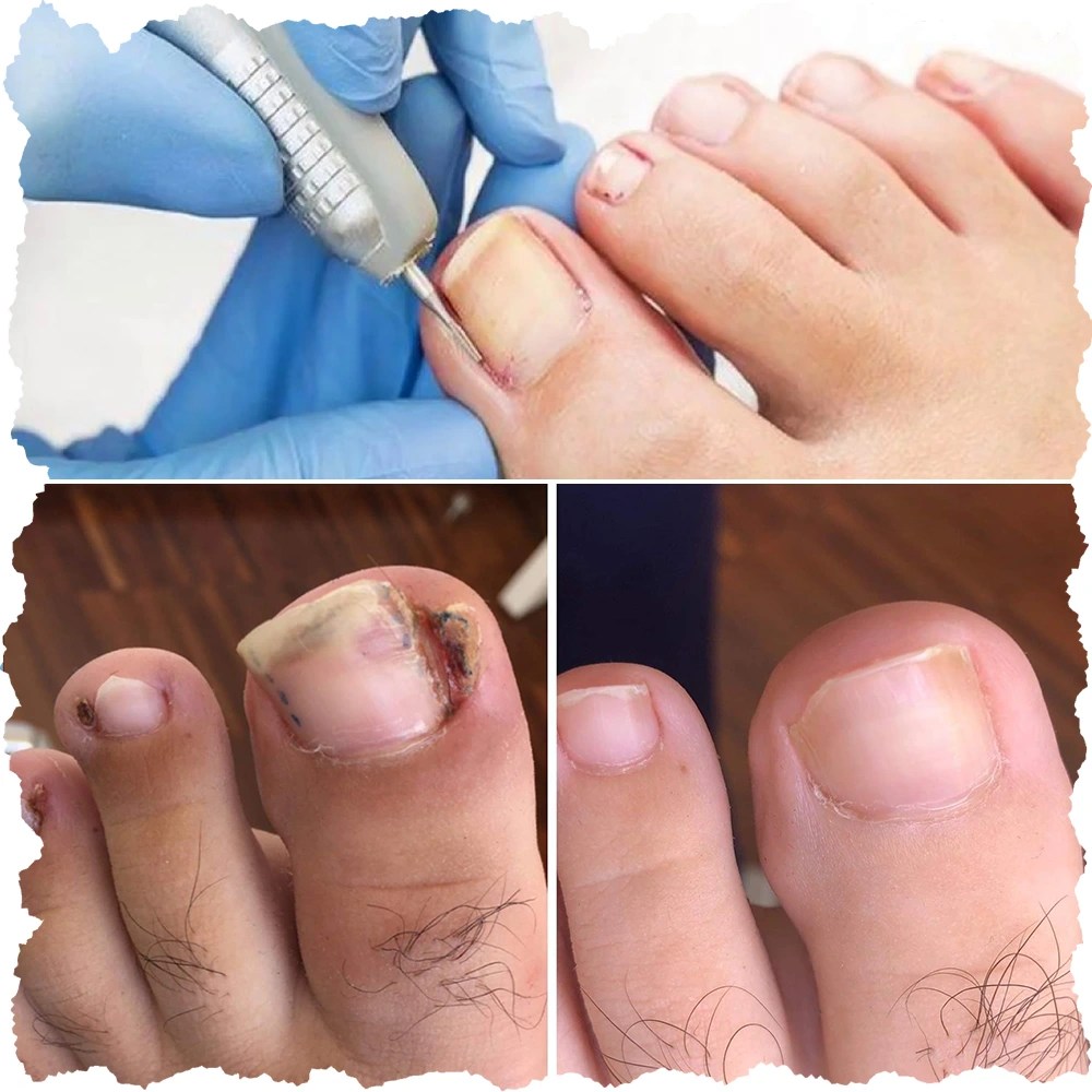 Nail surgery Dr Sajjas Clinic in Tirupati