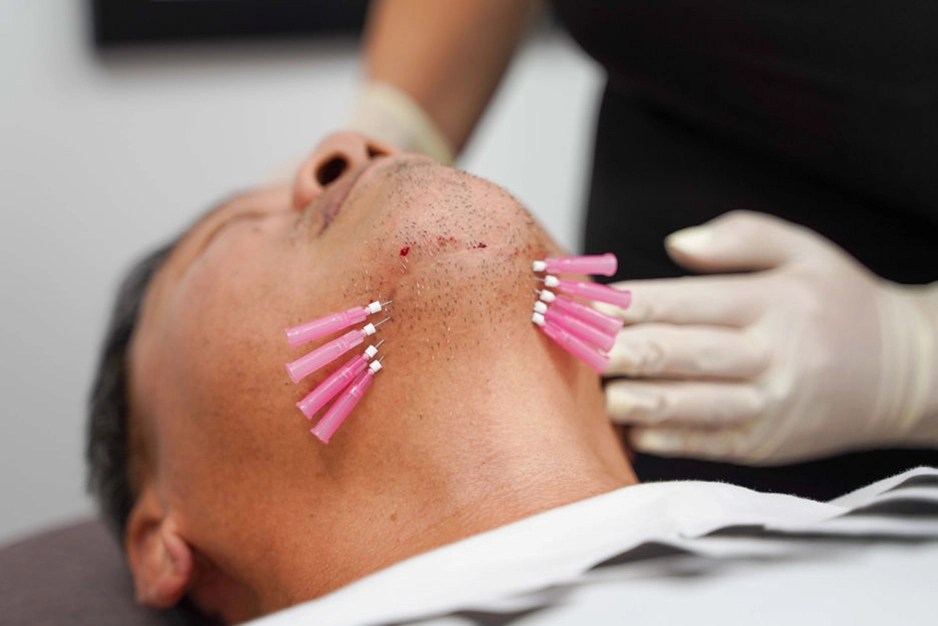 Thread lift Dr Sajjas Clinic in Tirupati