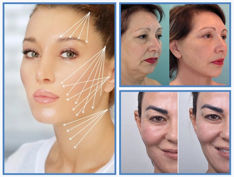 Thread lift Dr Sajjas Clinic in Tirupati