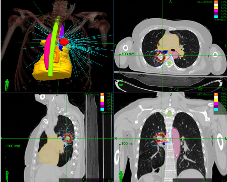 Stereotactic body radiation therapy Dr. Sanjoy Roy