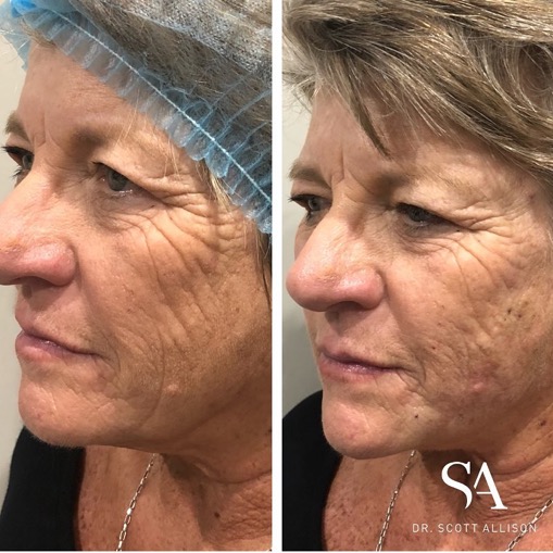 Thread Lift Brisbane — 30Min Procedure, LongTerm Results