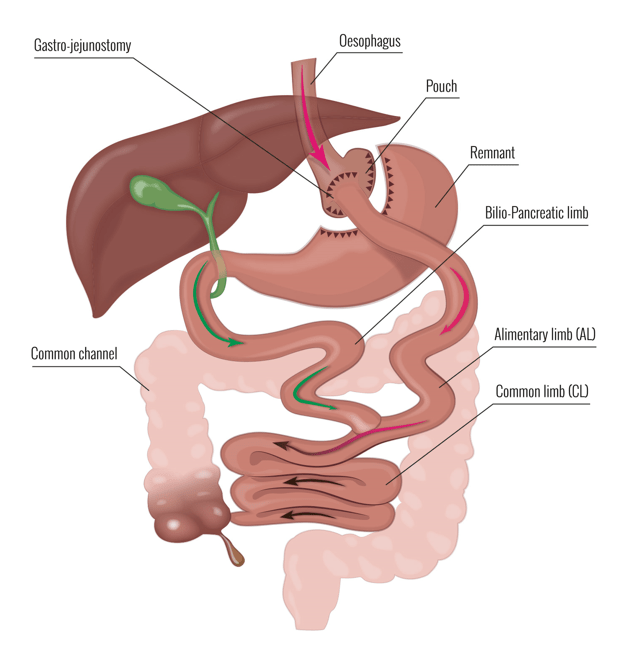 Primary Bariatric and Weight Loss Surgery Dr Scott Whiting