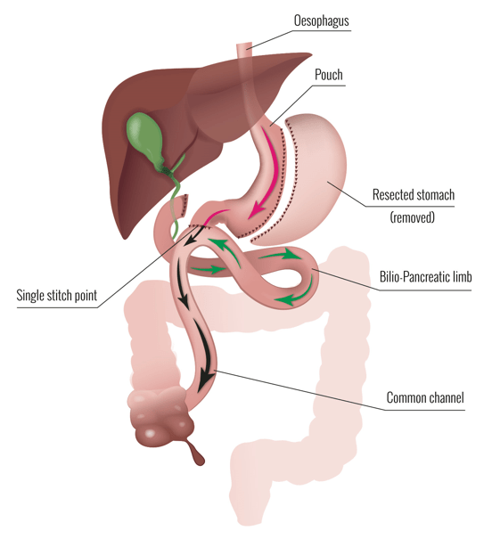 Primary Bariatric and Weight Loss Surgery Dr Scott Whiting