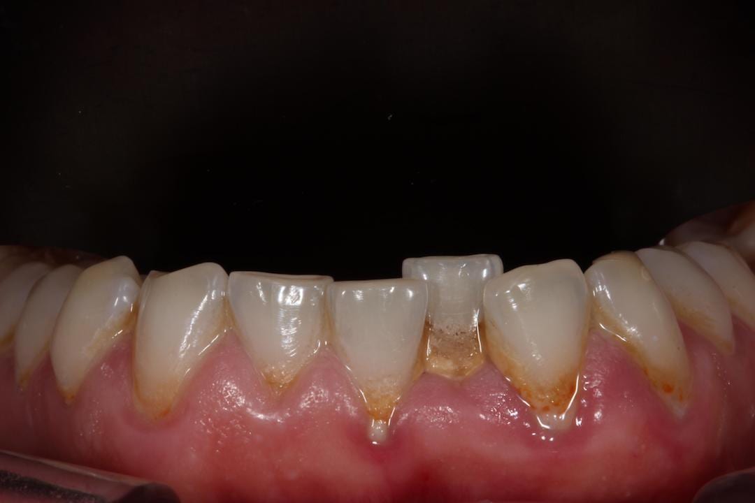 Emily Making a big front tooth look smaller Dr Gurs Sehmi