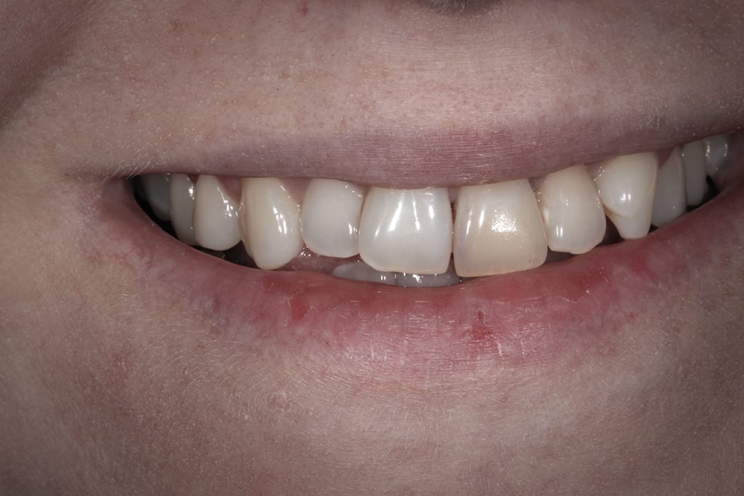 Improving Discoloured and Crooked Teeth With Porcelain