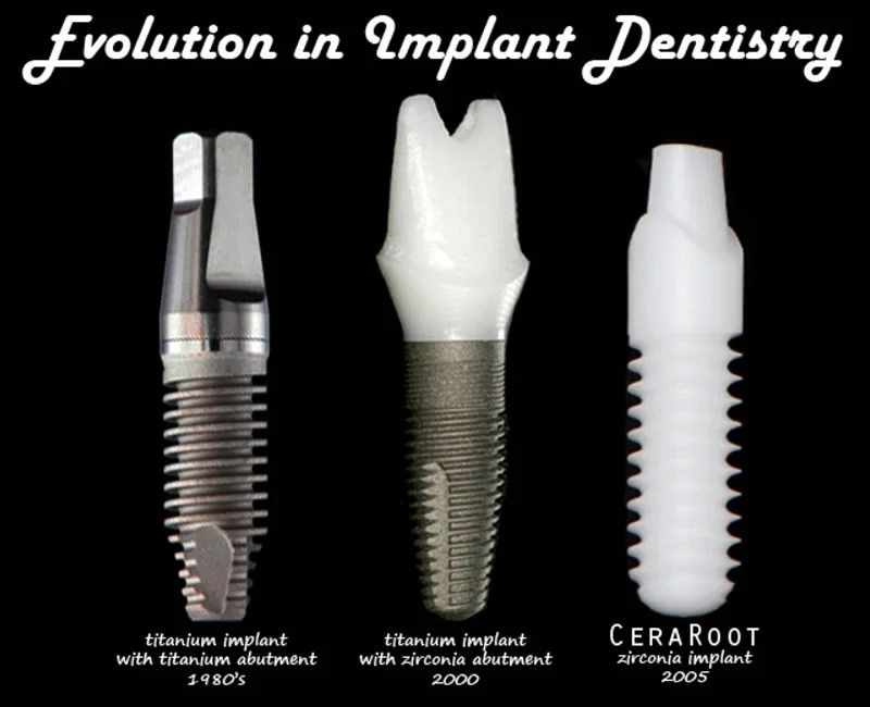 Ceramic Dental Implants Brooklin, Whitby, Oshawa Ontario Dentists