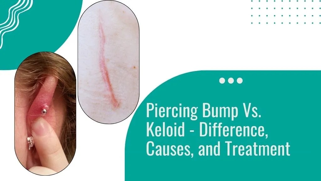 Keloid Piercing Cartilage