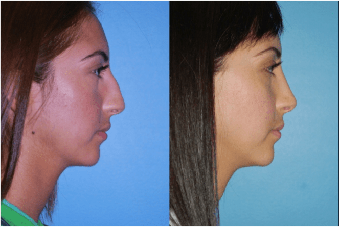 Rhinoplasty (Nose Job Surgery) In Naperville, Il |Dr. Sidle