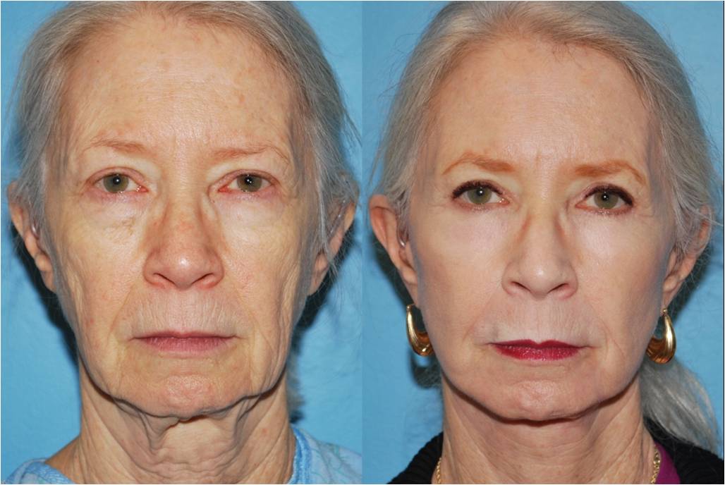 Before & After pictures Chemical Peel Treatment Chicago, IL Dr. Sidle