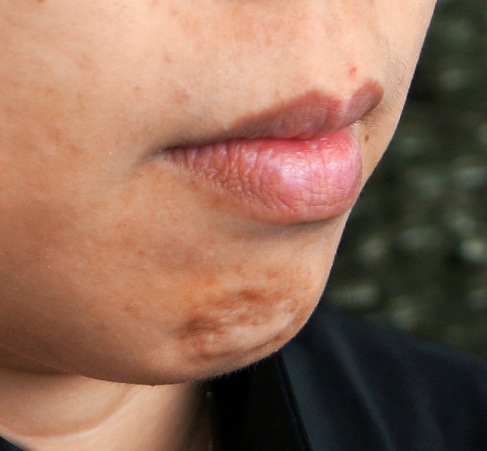 A Simple Method to Enhance Your Profile Botox Chin Dr