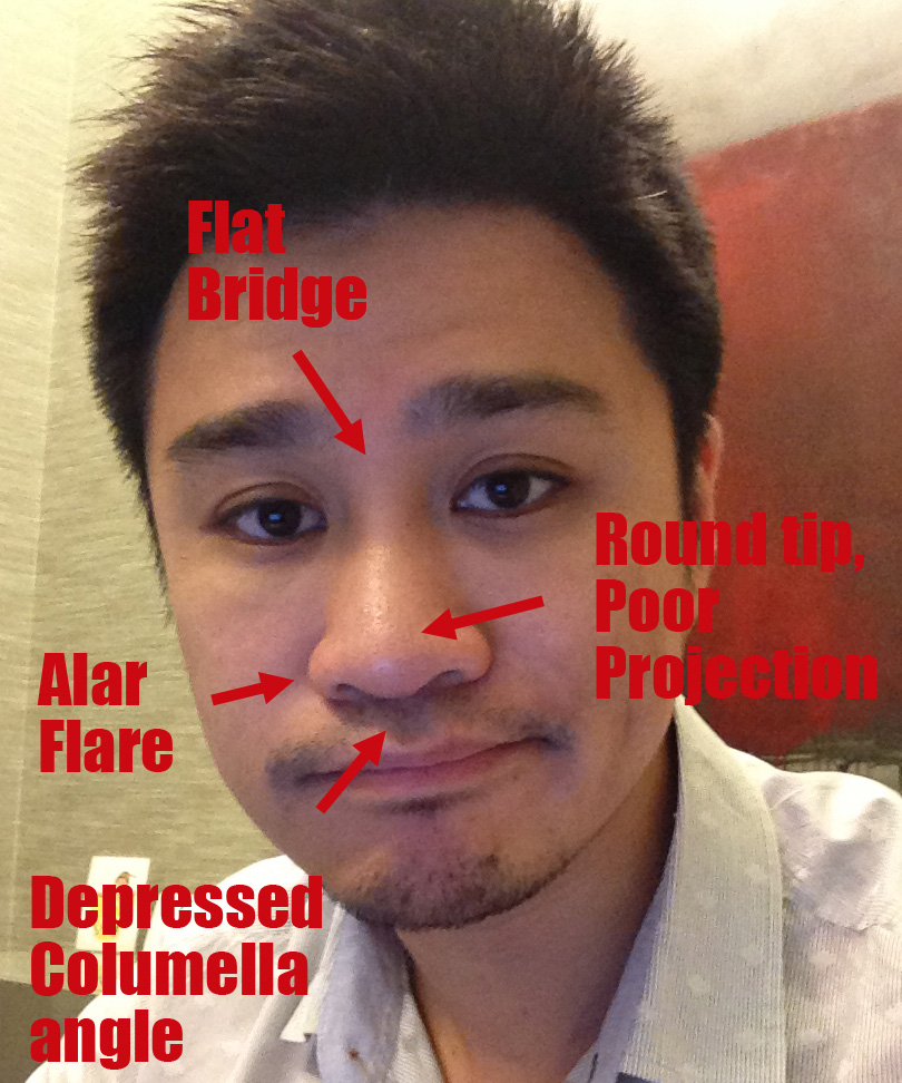 Achieve a Beautiful Nose with Hyaluronic Acid Nose Fillers