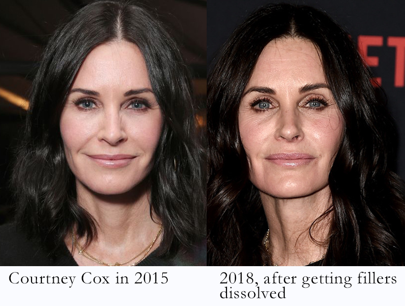 WHY CHEEK FILLERS MAKE YOU PUFFY, AND HOW YOU CAN HAVE A NATURAL RESULT