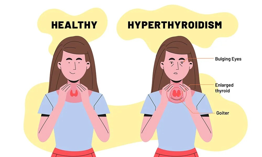 Hyperthyroidism Overactive Thyroid Gland ! Dr. Smita Ramachandran
