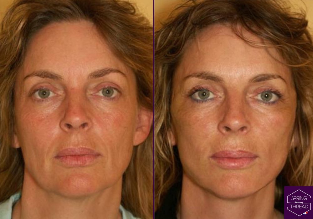 Spring Thread Lift Dr Sobia Medispa