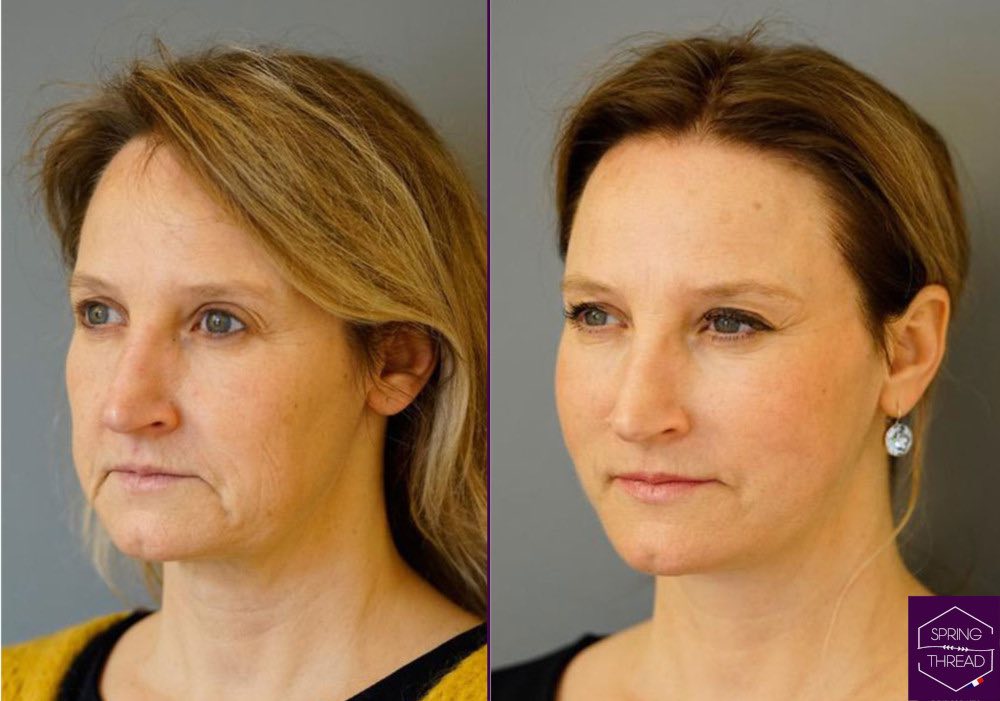 Spring Thread Lift Dr Sobia Medispa