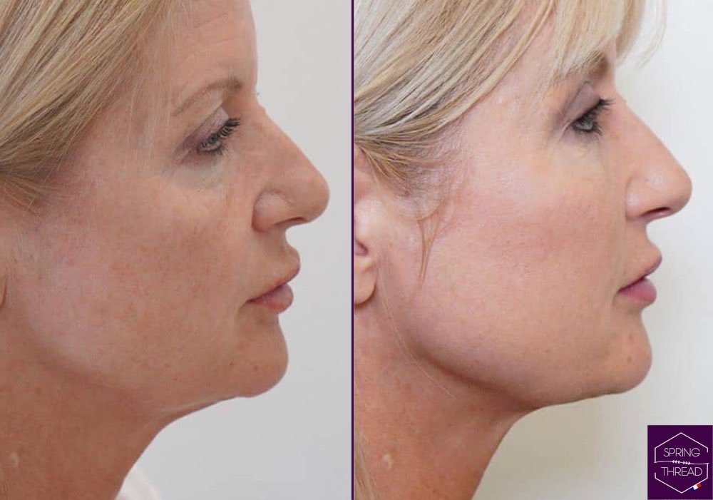 Spring Thread Lift Dr Sobia Medispa