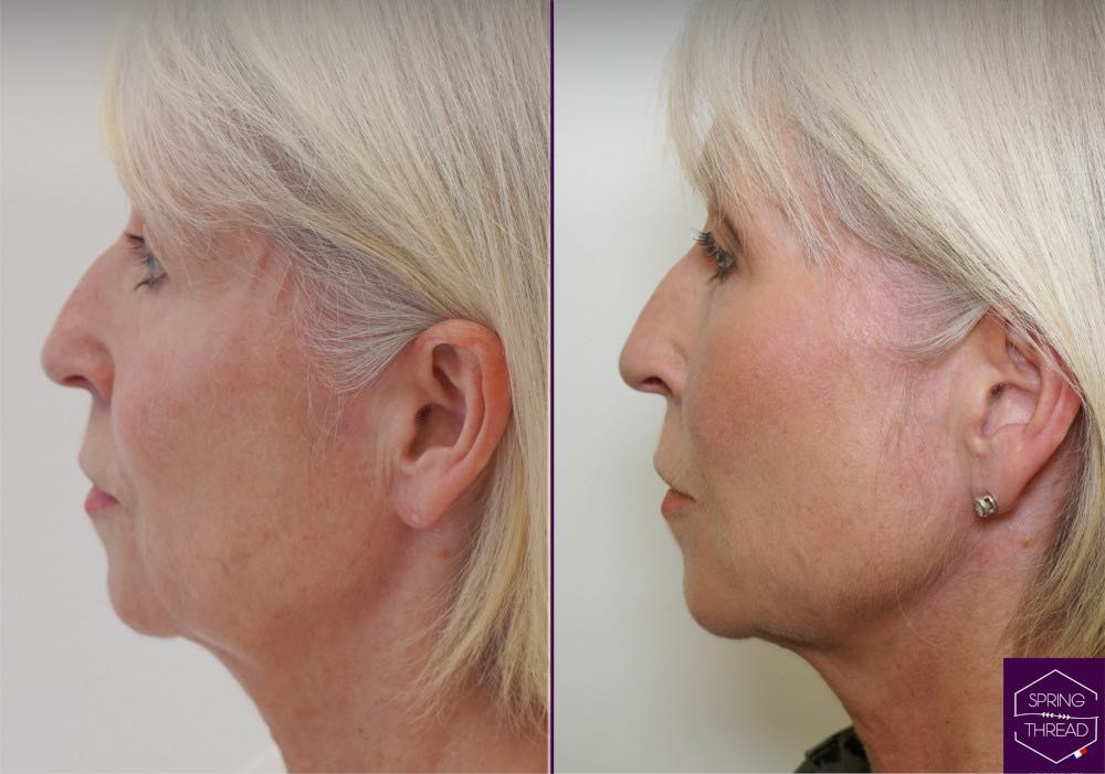 Spring Thread Lift Dr Sobia Medispa