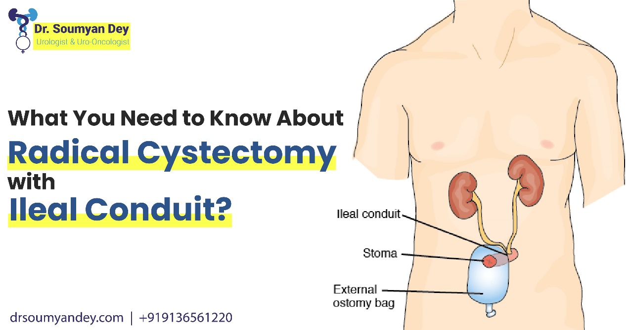 Understanding Radical Cystectomy with Ileal Conduit