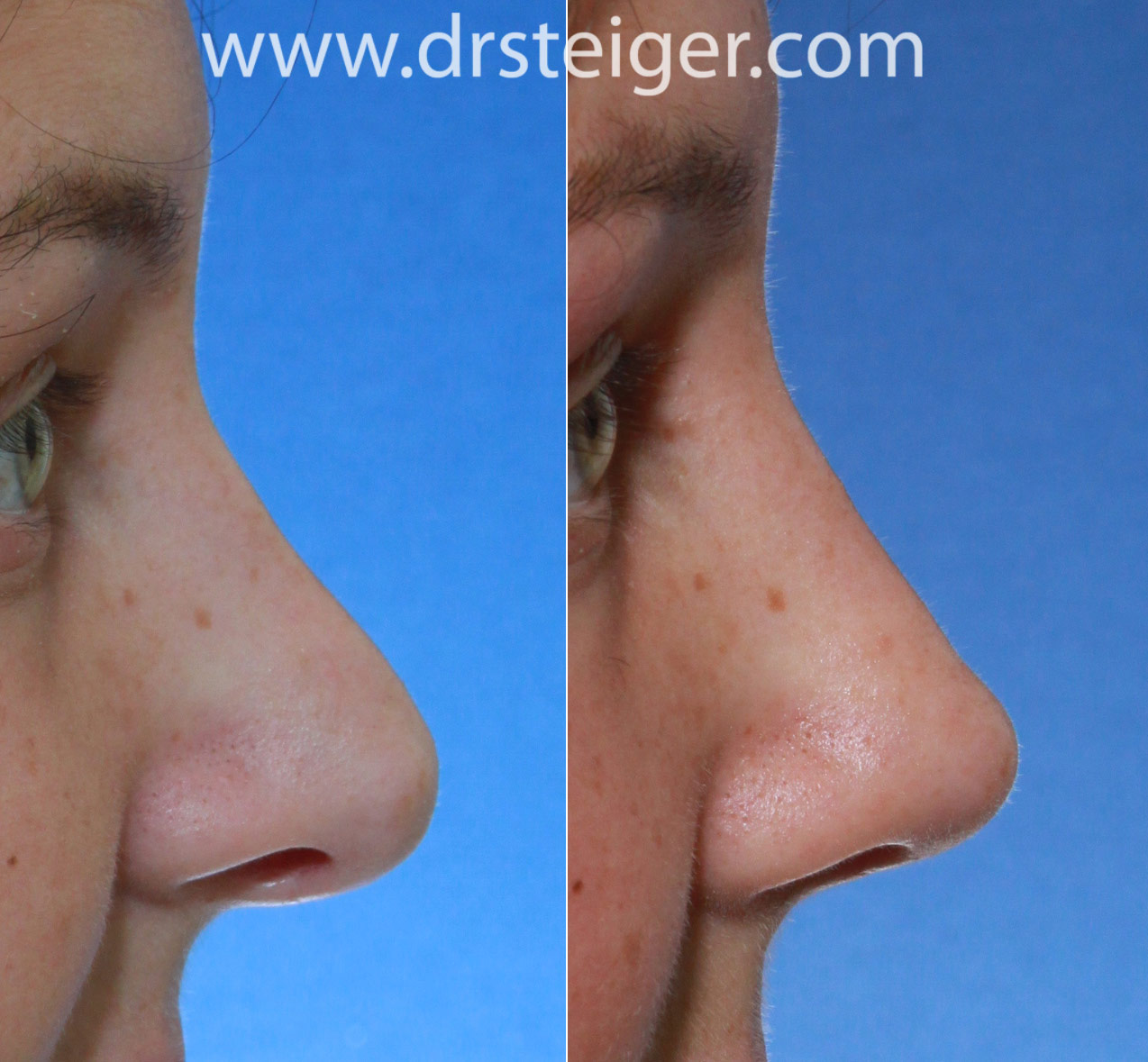 Revision Rhinoplasty Before and After Photos