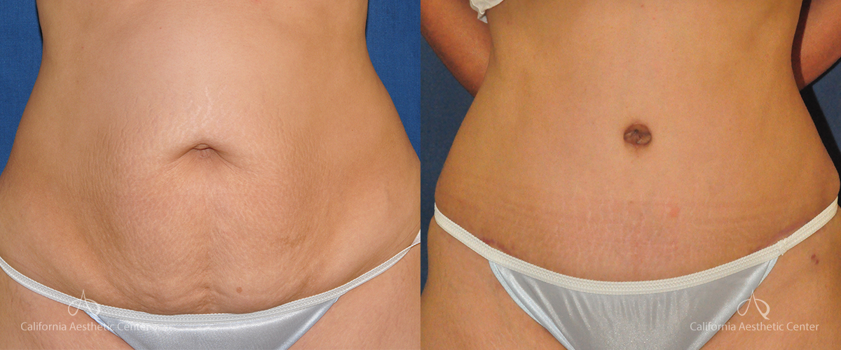 Tummy Tuck California Aesthetic Center