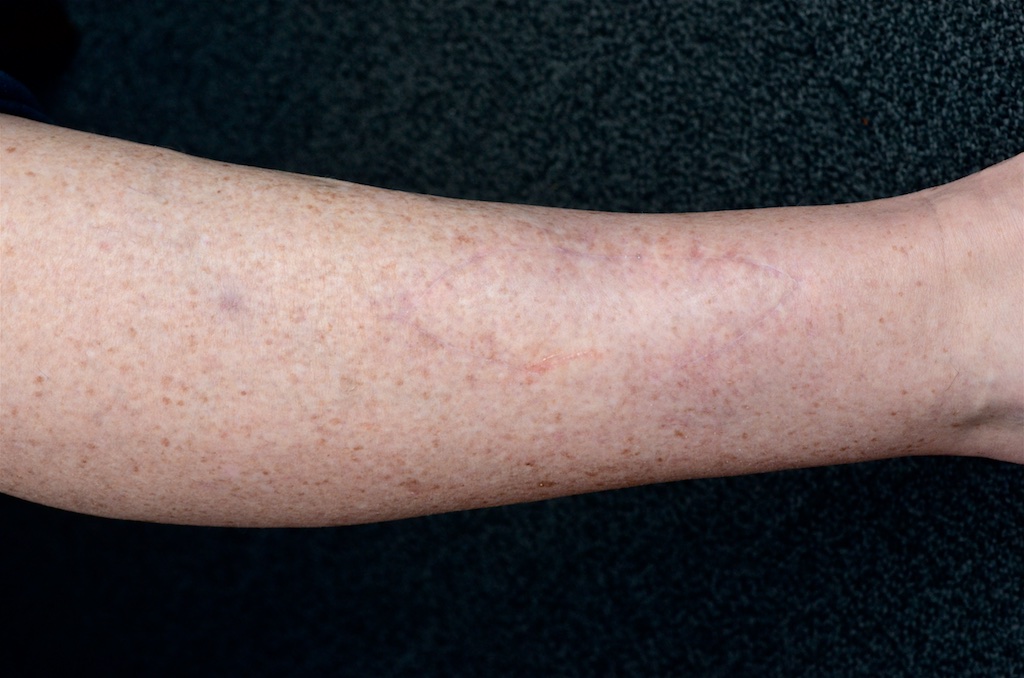 Skin Cancer Surgery & Repair Dr Stretch