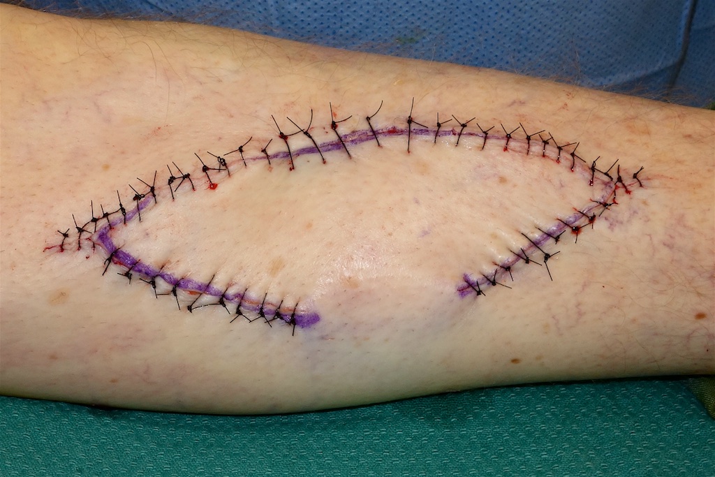Skin Cancer Surgery & Repair Dr Stretch
