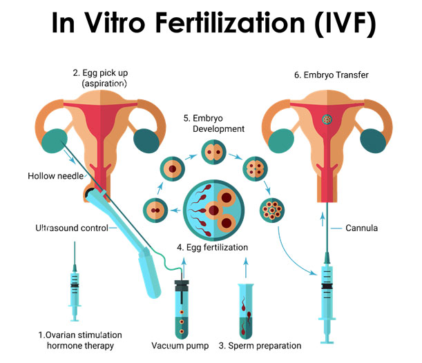 IVF In Vitro Fertilisation Process Dr. Suparna Banerjee