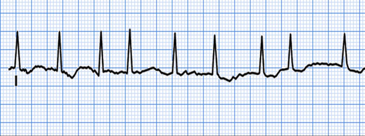 Is atrial fibrillation a benign arrhythmia ? Dr.S