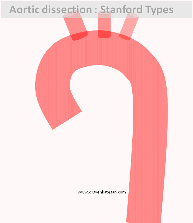 aortic dissection Dr.S.Venkatesan MD