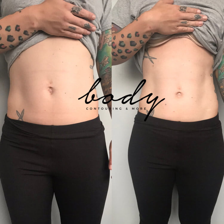 Body Contouring Services, Ultrasonic, Lipo, Vacuum Dr. Tara Rasta Anaheim, CA