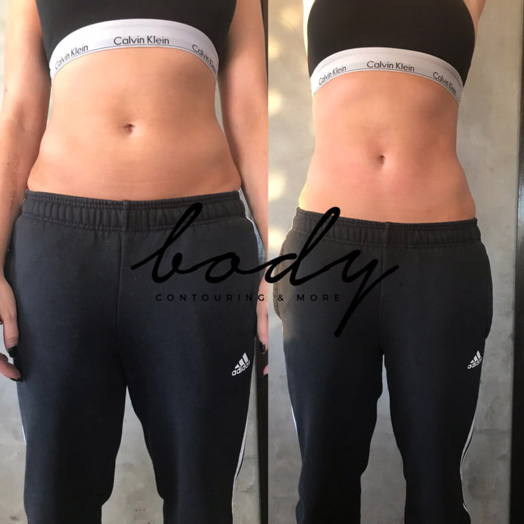 Body Contouring Services, Ultrasonic, Lipo, Vacuum Dr. Tara Rasta Anaheim, CA