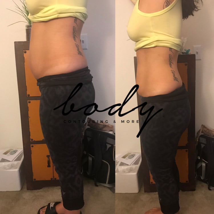 Body Contouring Services, Ultrasonic, Lipo, Vacuum Dr. Tara Rasta Anaheim, CA