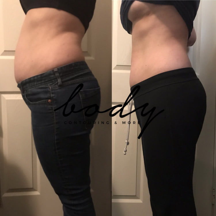 Body Contouring Services, Ultrasonic, Lipo, Vacuum Dr. Tara Rasta Anaheim, CA