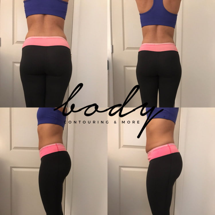 Body Contouring Services, Ultrasonic, Lipo, Vacuum Dr. Tara Rasta Anaheim, CA