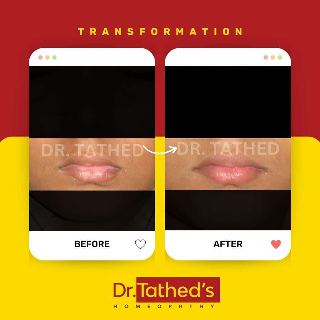 Online Vitiligo Homeopathy Treatment Dr. Tathed's Homeopathy