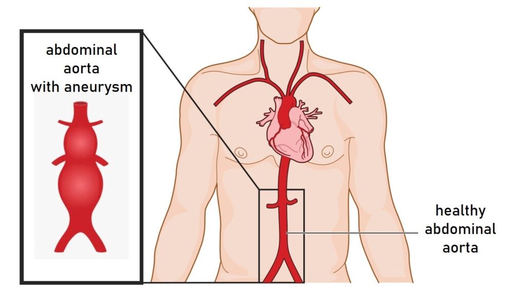 Abdominal Aortic Aneurysm Causes, Treatment and Prevention
